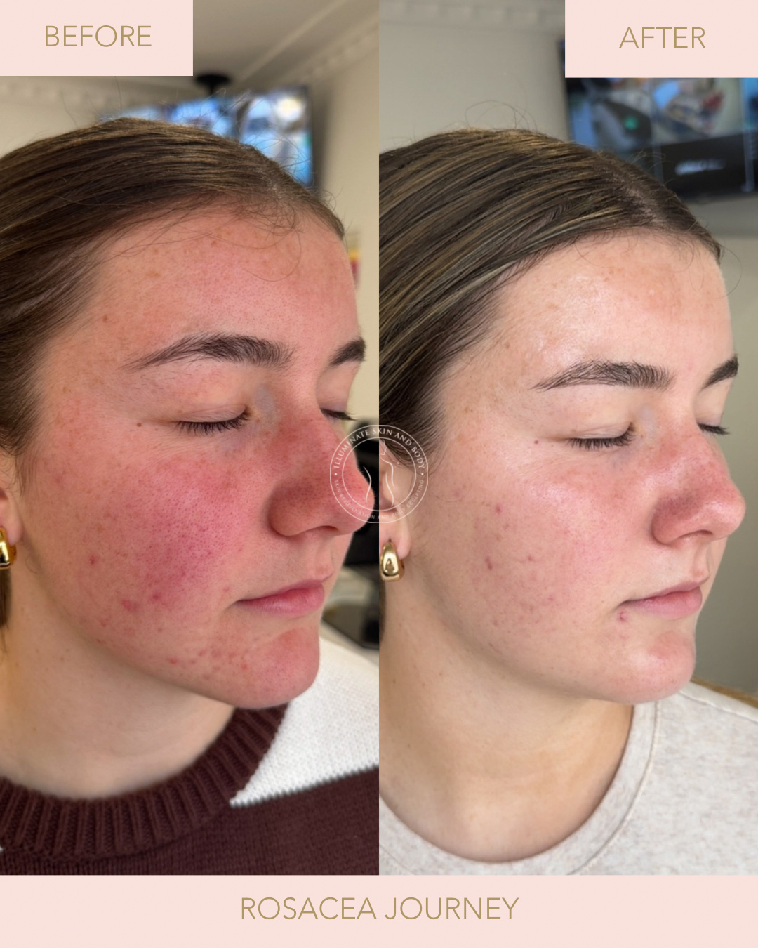 Client skin result before and after treatment at Illuminate Skin and Body