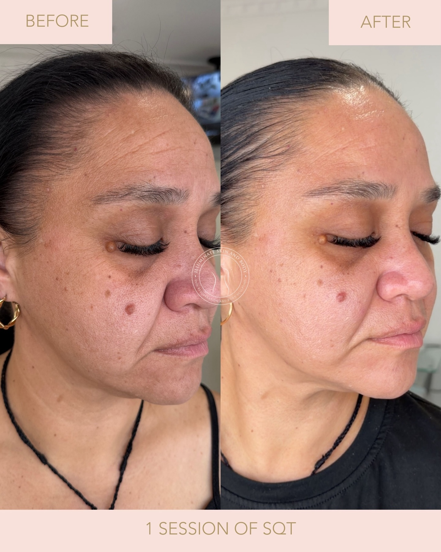 Client skin result before and after treatment at Illuminate Skin and Body