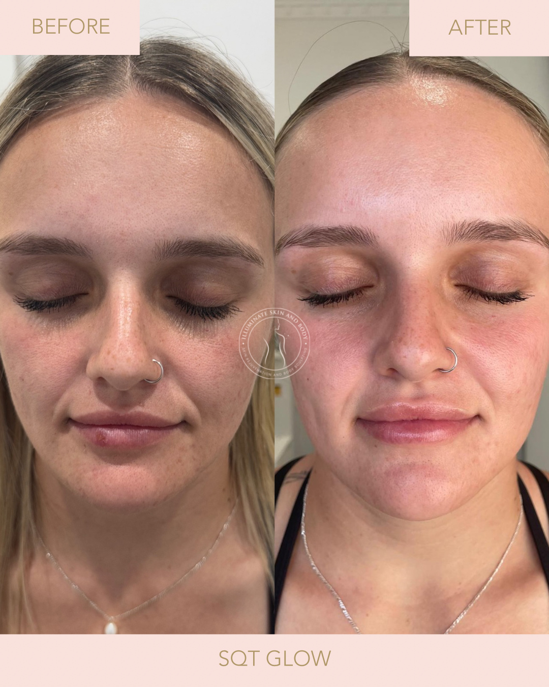 Client skin result before and after treatment at Illuminate Skin and Body