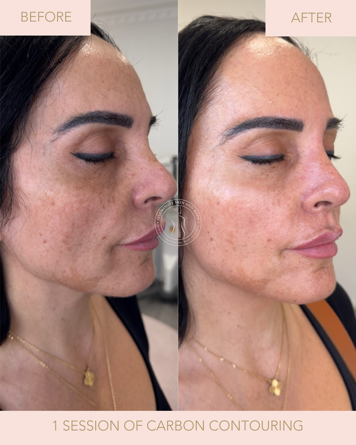 Client skin result before and after treatment at Illuminate Skin and Body