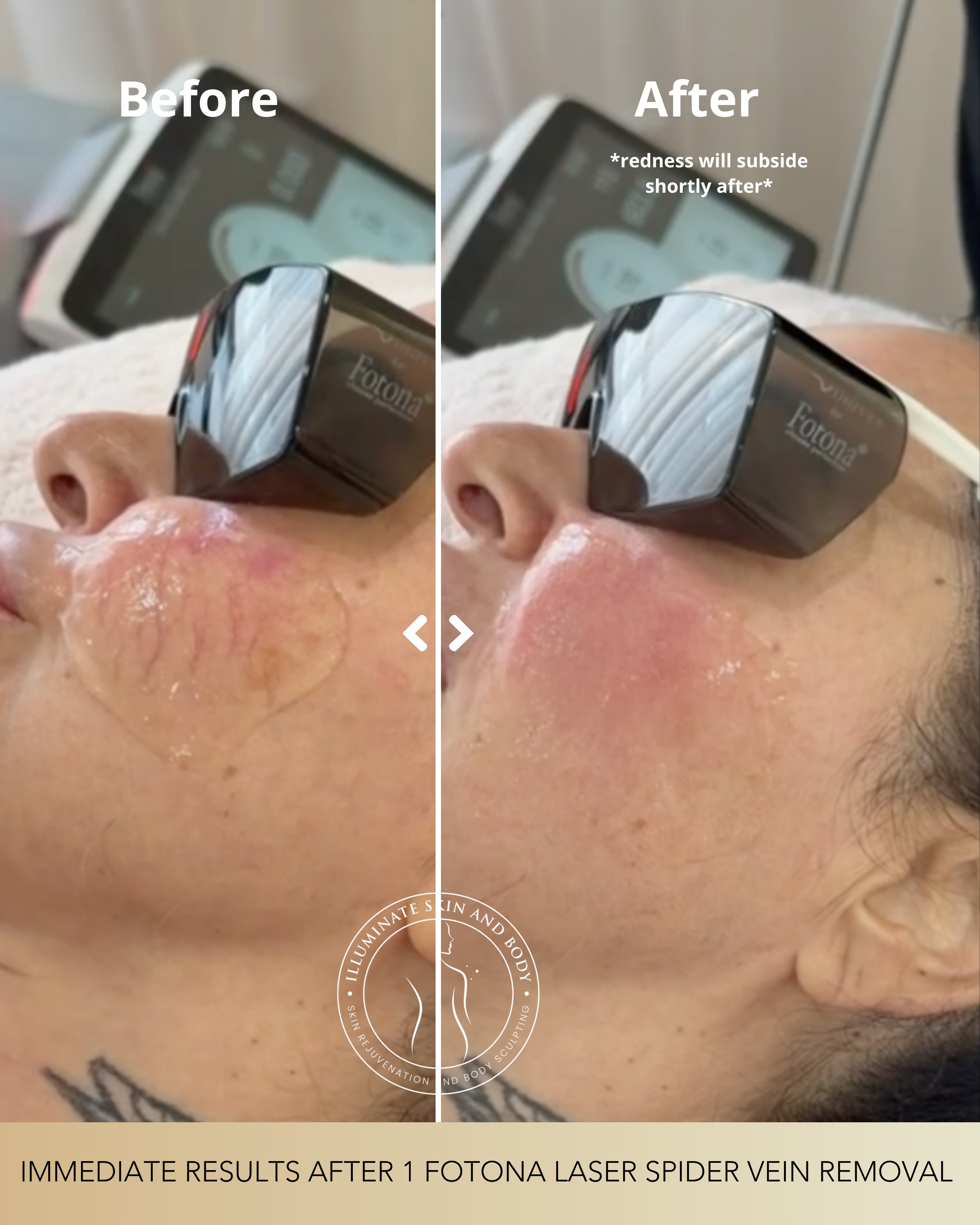 Client skin result before and after treatment at Illuminate Skin and Body