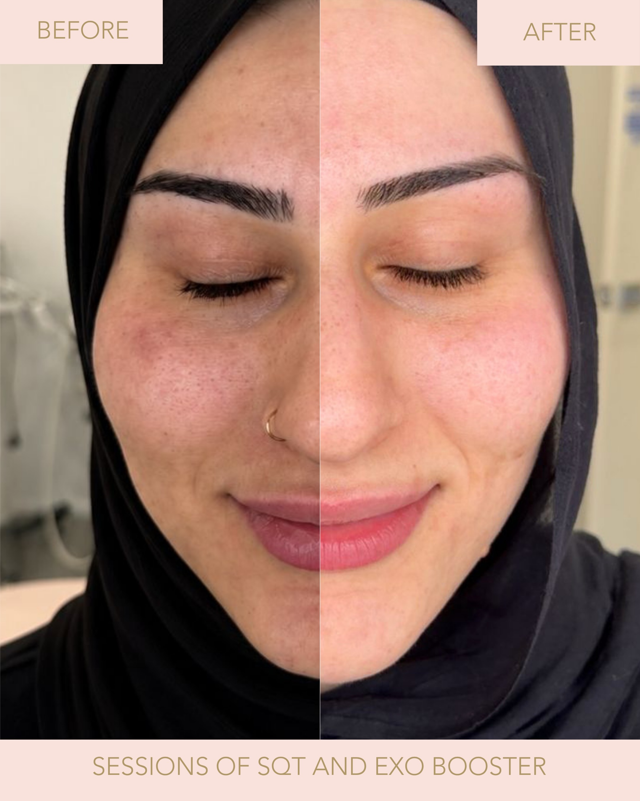Client skin result before and after treatment at Illuminate Skin and Body