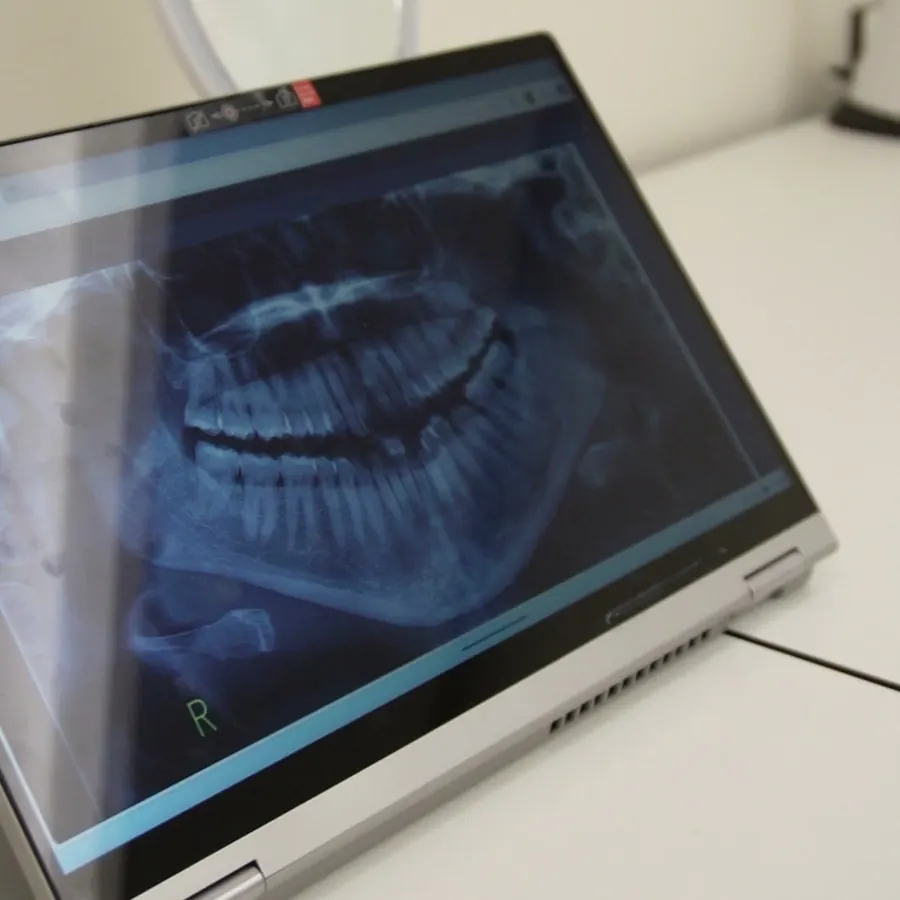 Radiografía panorámica dental en pantalla durante el diagnóstico