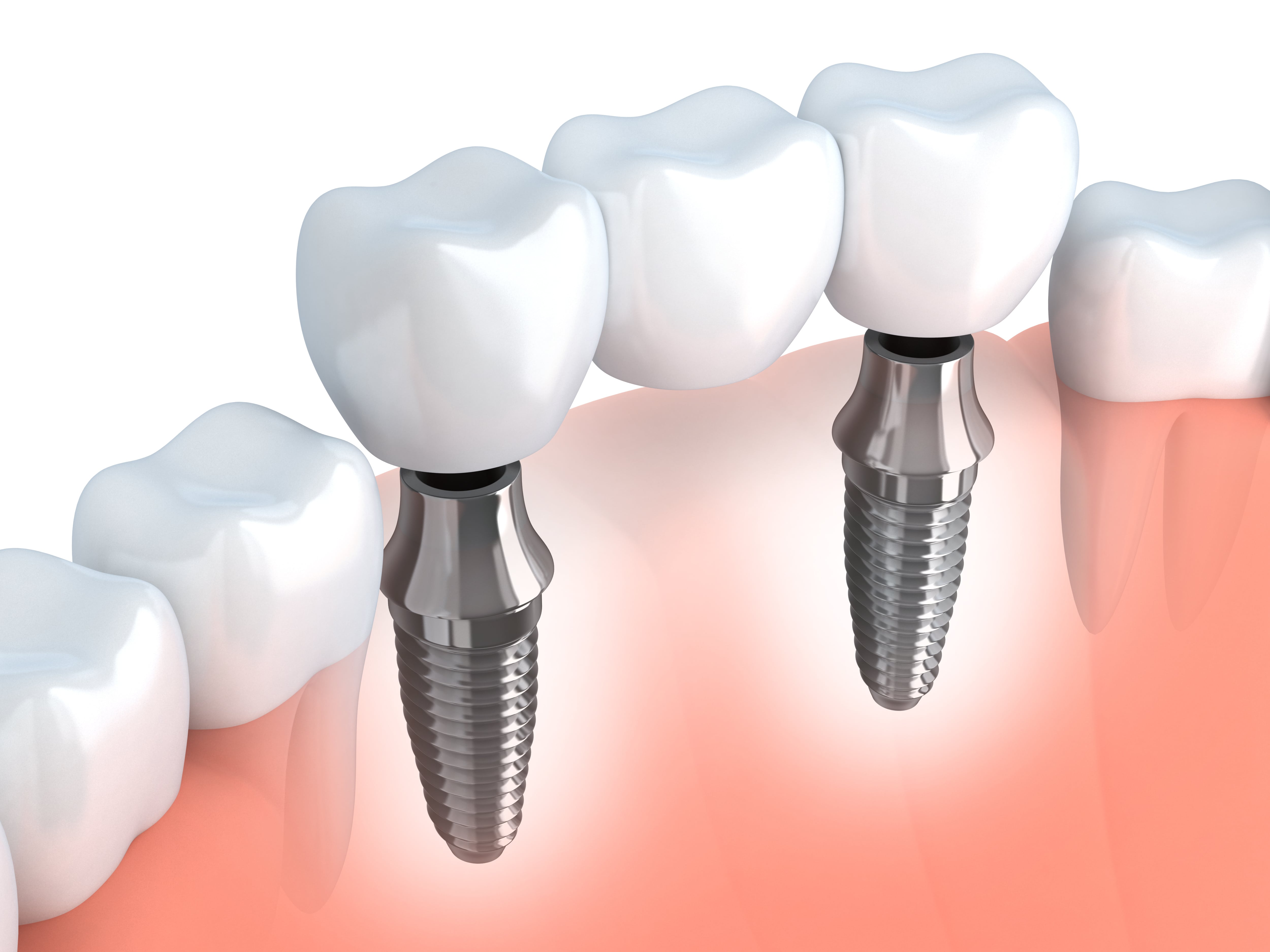 Model of replacement crowns attaching to a dental implant