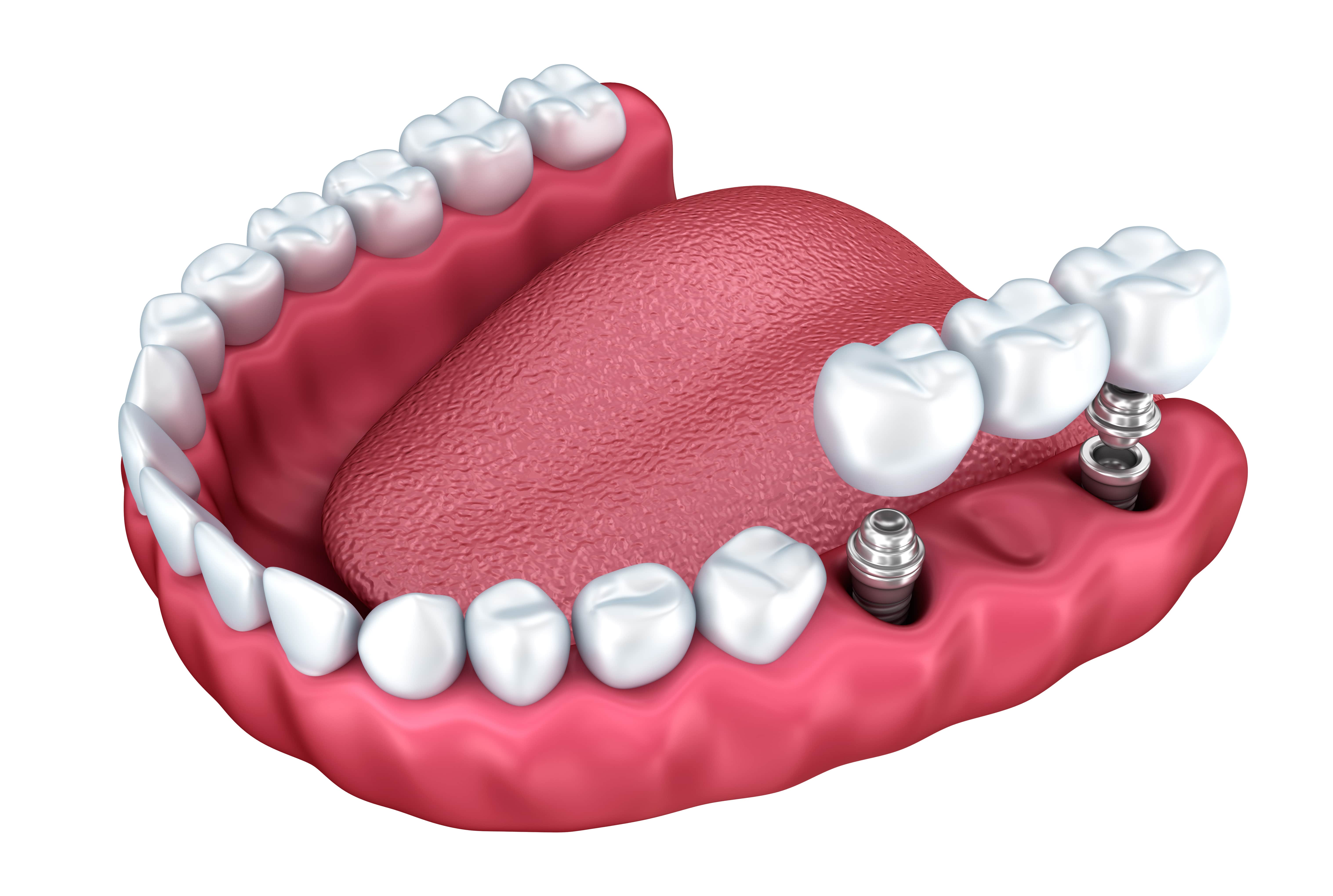 3d model of a mouth with two dental implants