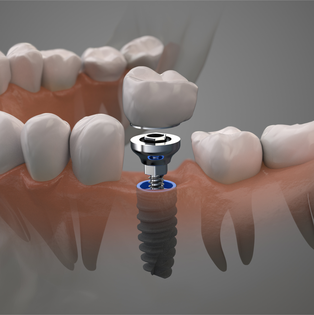 Dental Implants