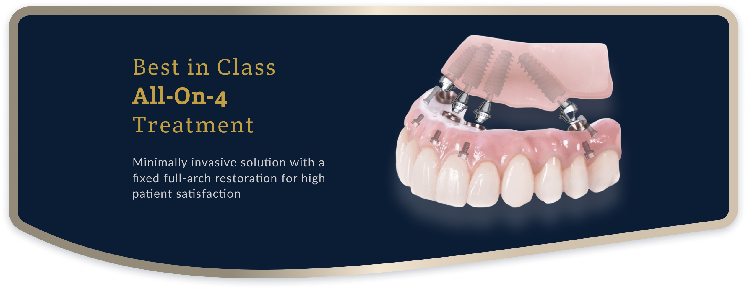 Showcase of all-on-4 dental implants, where a full row of teeth is replaced with just four implant attachments