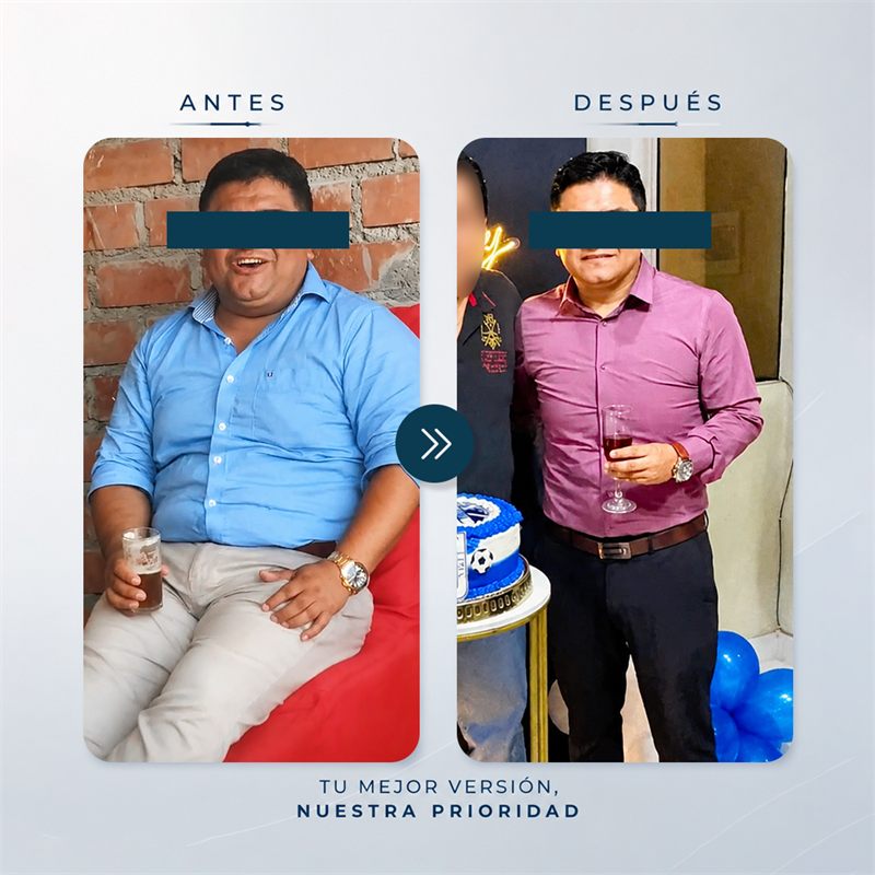 Paciente antes y después de su manga gástrica en la Clínica Solari.