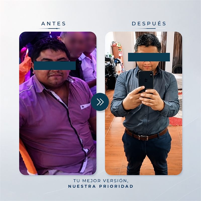 Paciente antes y después de su manga gástrica en la Clínica Solari.