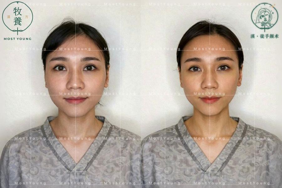 真实案例:面部调理前后对比