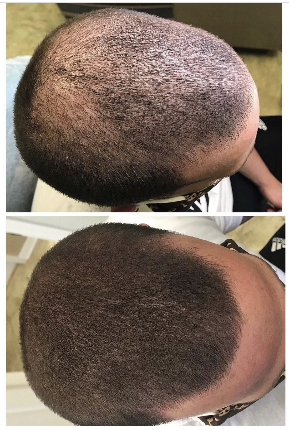 <h3><strong>SMP for Minor Hair Loss</strong></h3>