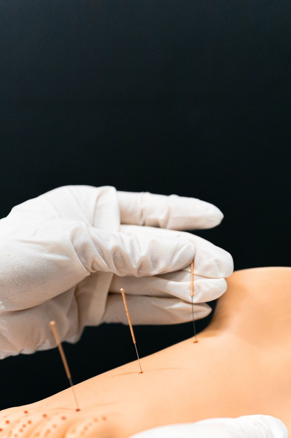 Acupuncture treatment