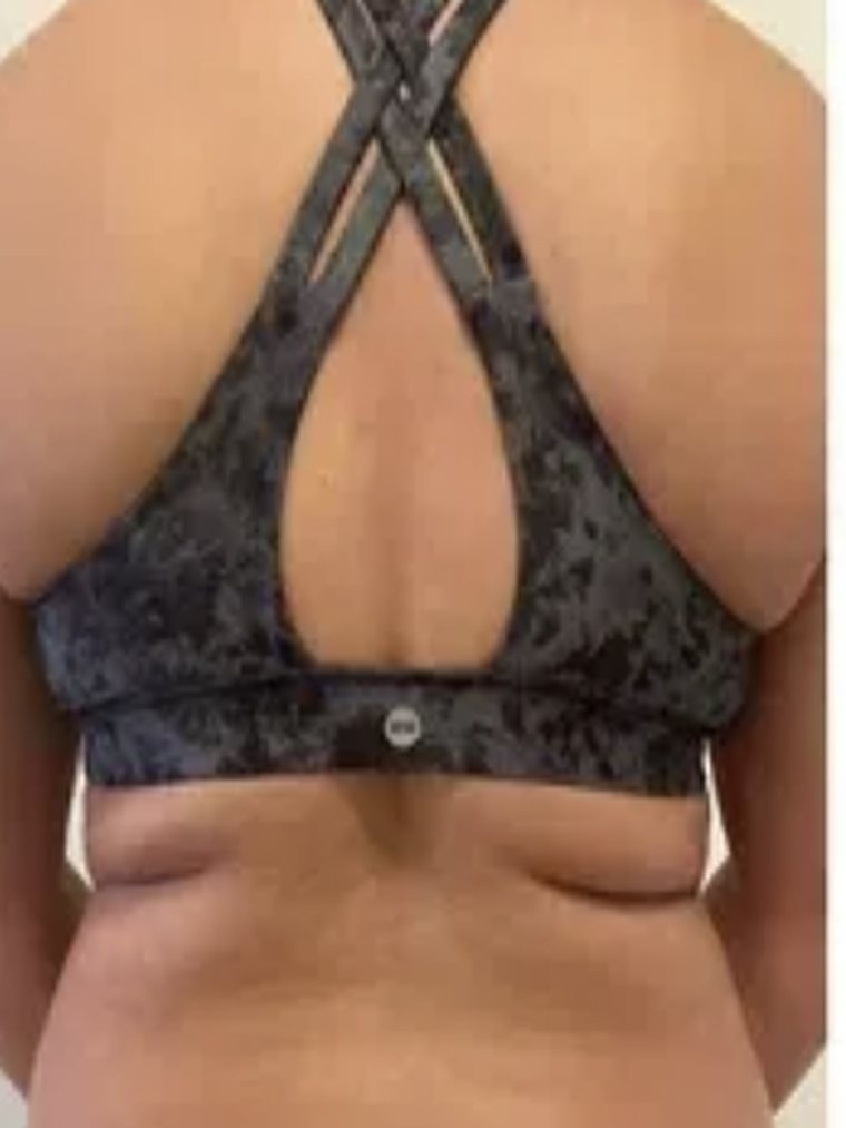 CryoSlimming, back and bra line — before treatment