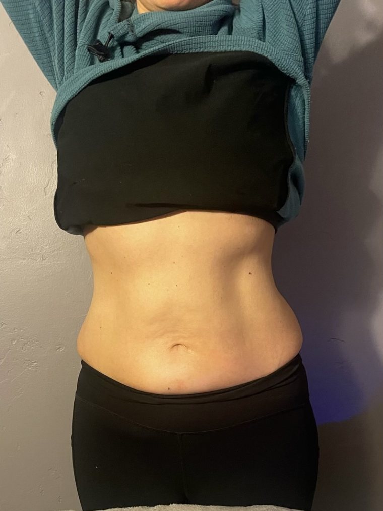 CryoSlimming and CryoToning, abdomen — after treatment