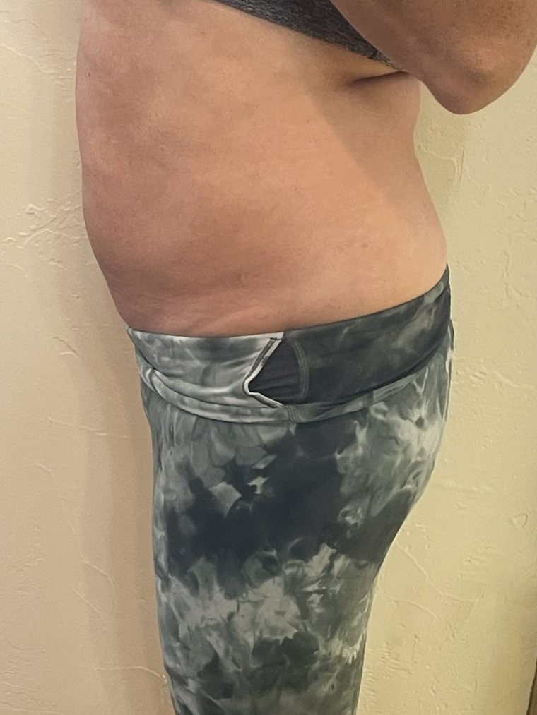 CryoSlimming, waist and flank — before treatment