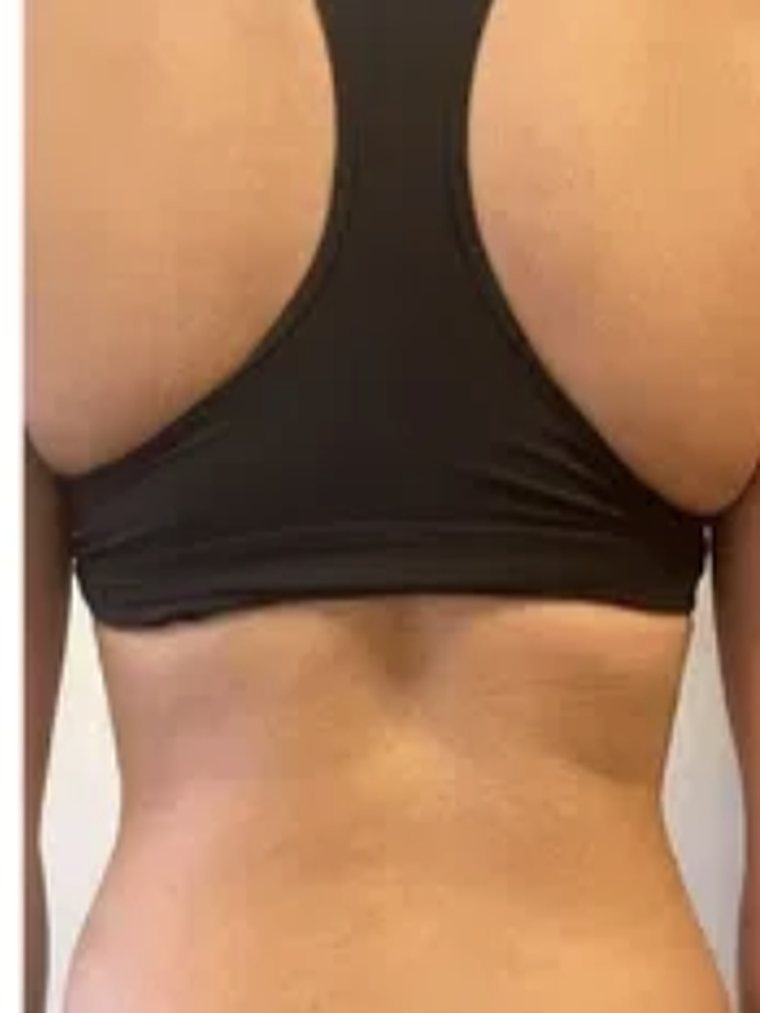 CryoSlimming, back and bra line — after treatment