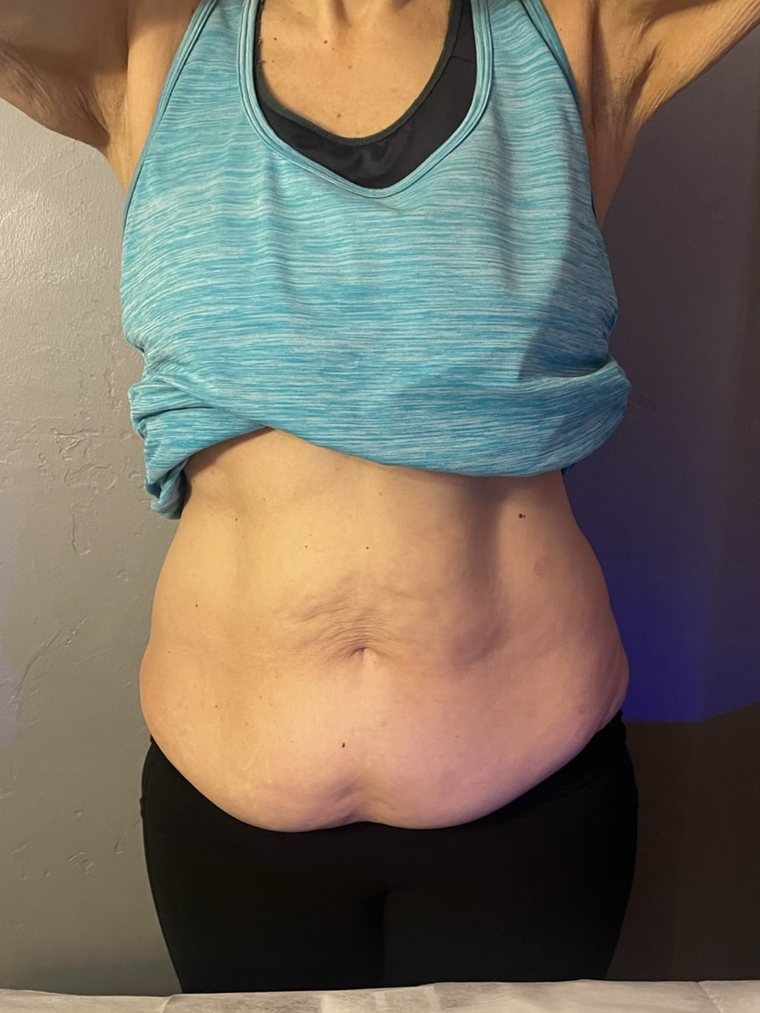 CryoSlimming and CryoToning, abdomen — before treatment