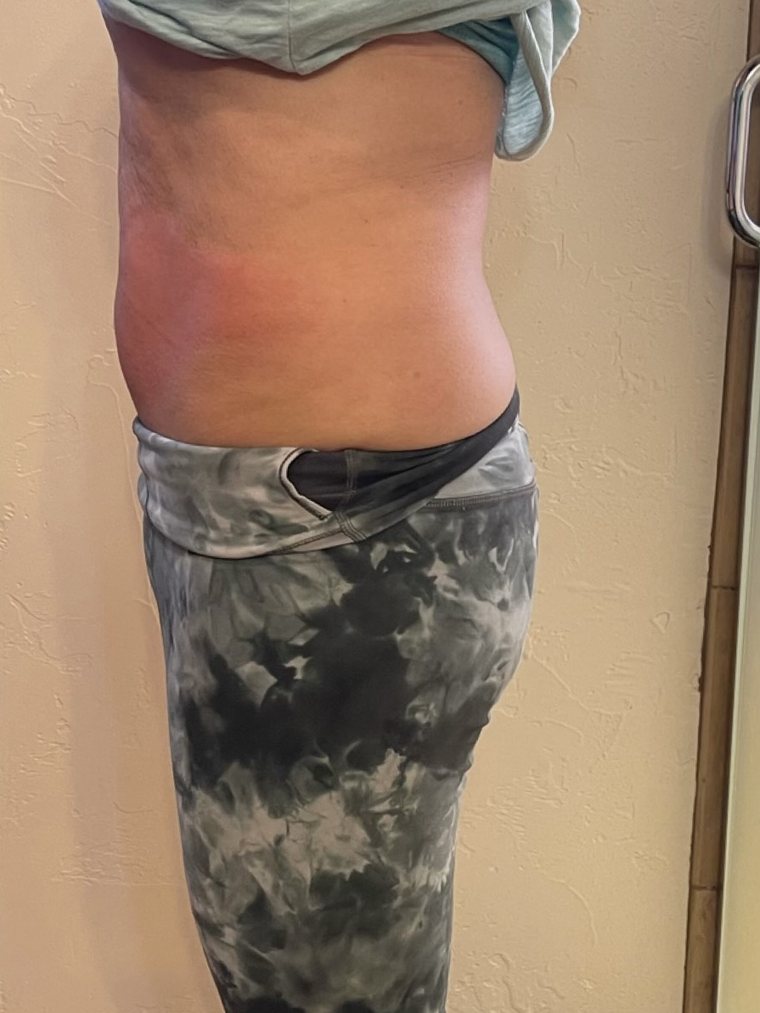 CryoSlimming, waist and flank — after treatment