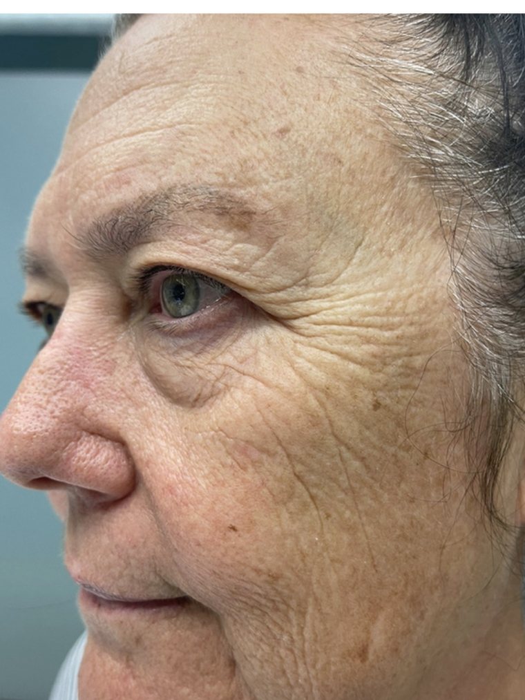 CryoFacial, face and jawline — before treatment