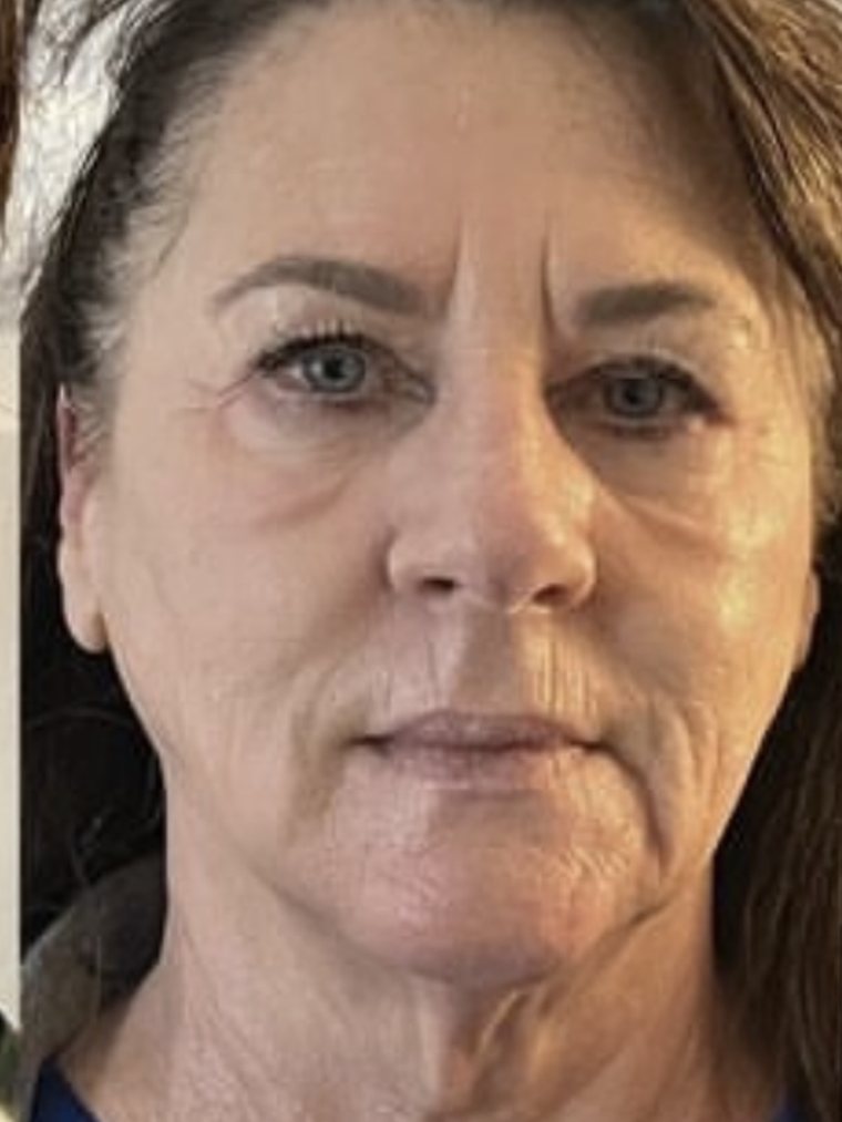 CryoFacial, face and neck — after treatment