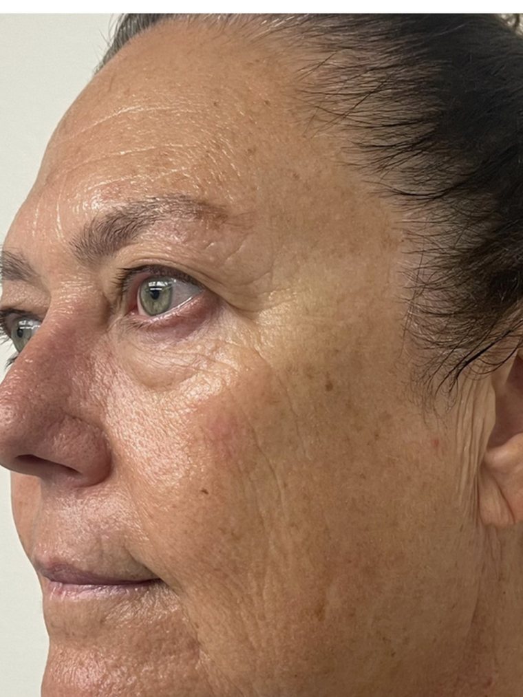 CryoFacial, face and jawline — after treatment