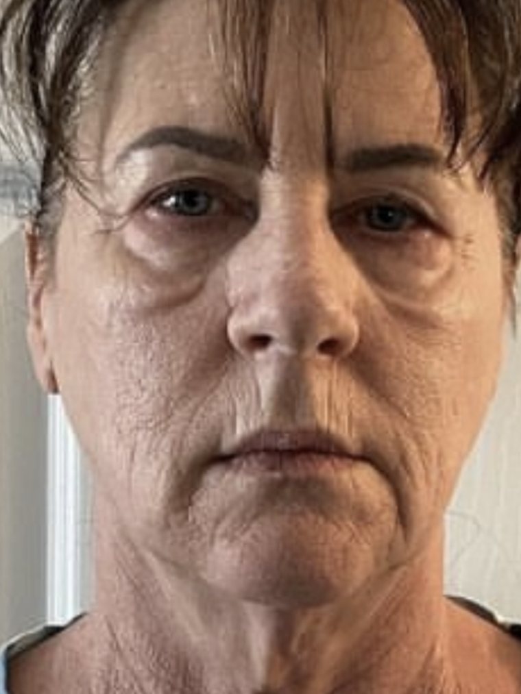 CryoFacial, face and neck — before treatment