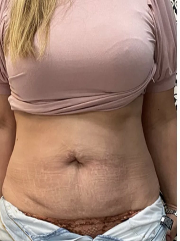 CryoToning, abdomen — before treatment