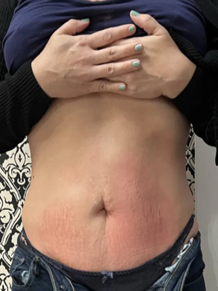 CryoToning, abdomen — after treatment