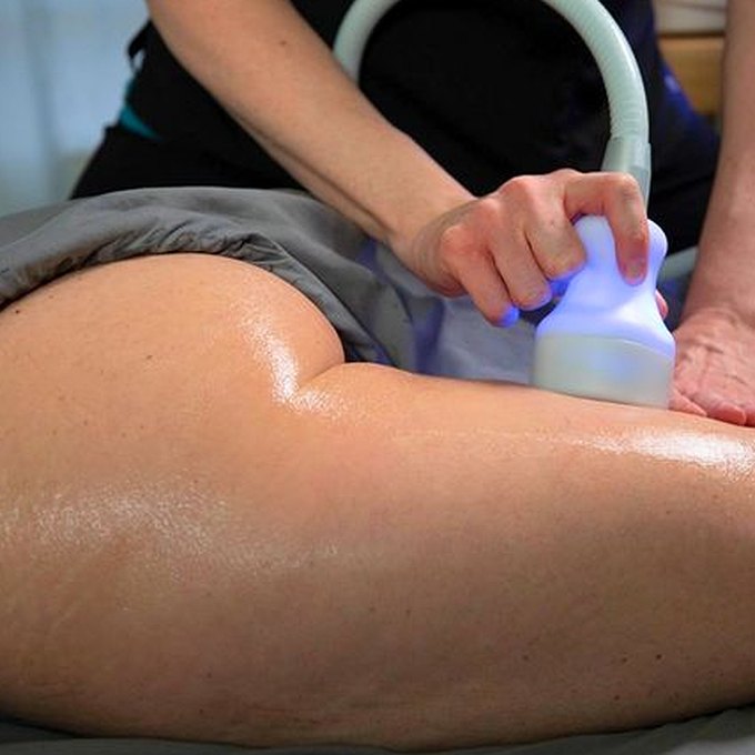 CryoToning treatment on the thigh