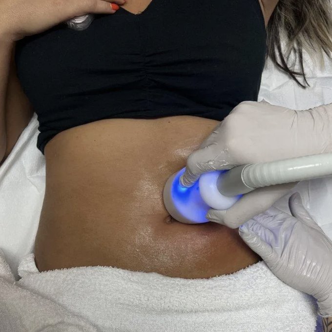 CryoSlimming treatment on the abdomen