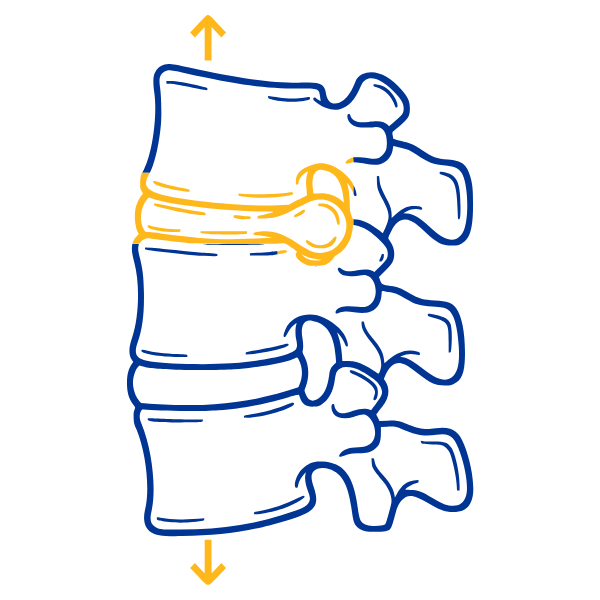 Illustration of a spinal disc between two vertebrae