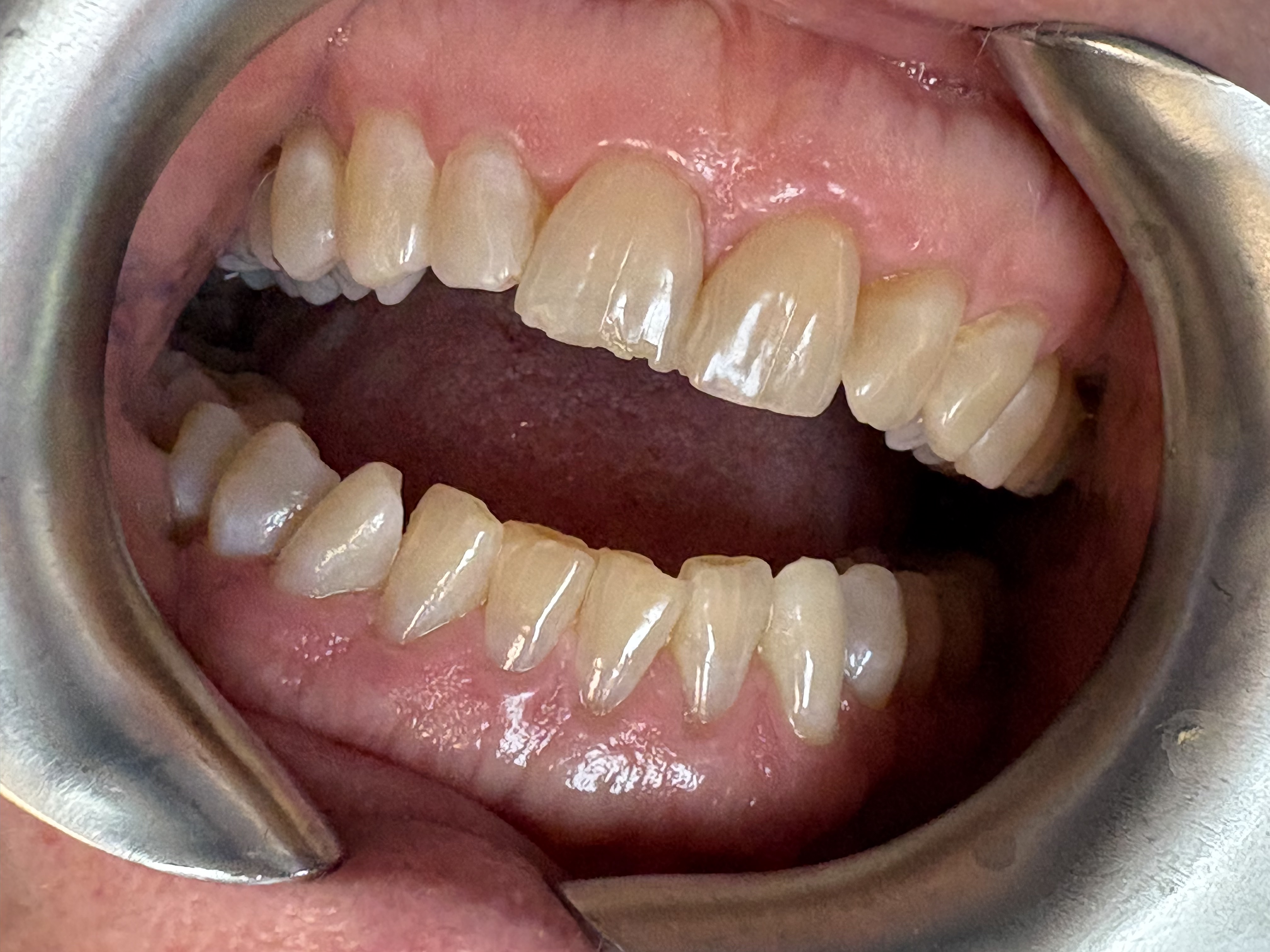Repairing Chipped Front Teeth before treatment at Aston Dental