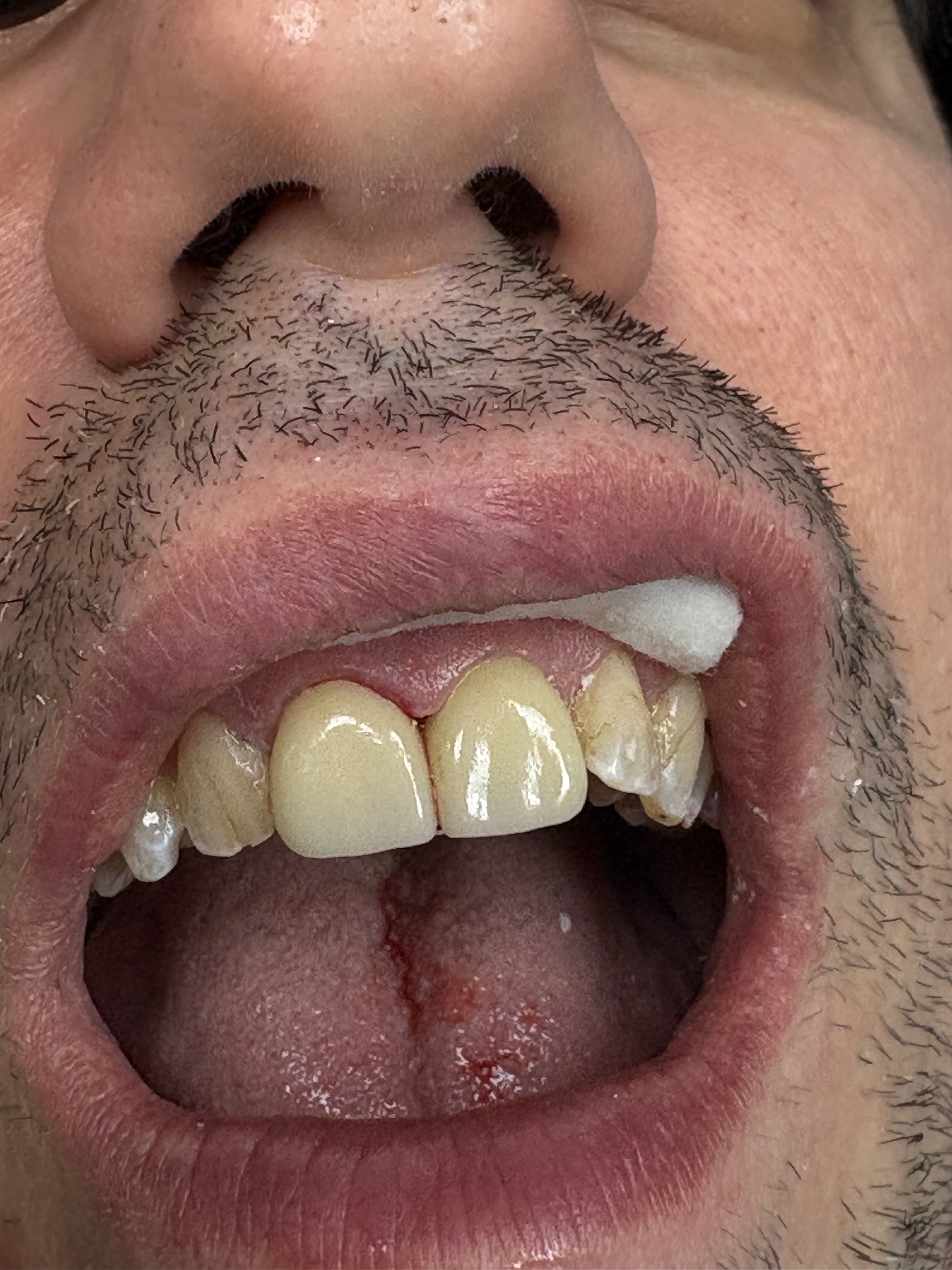 Cosmetic Porcelain Crowns after treatment at Aston Dental