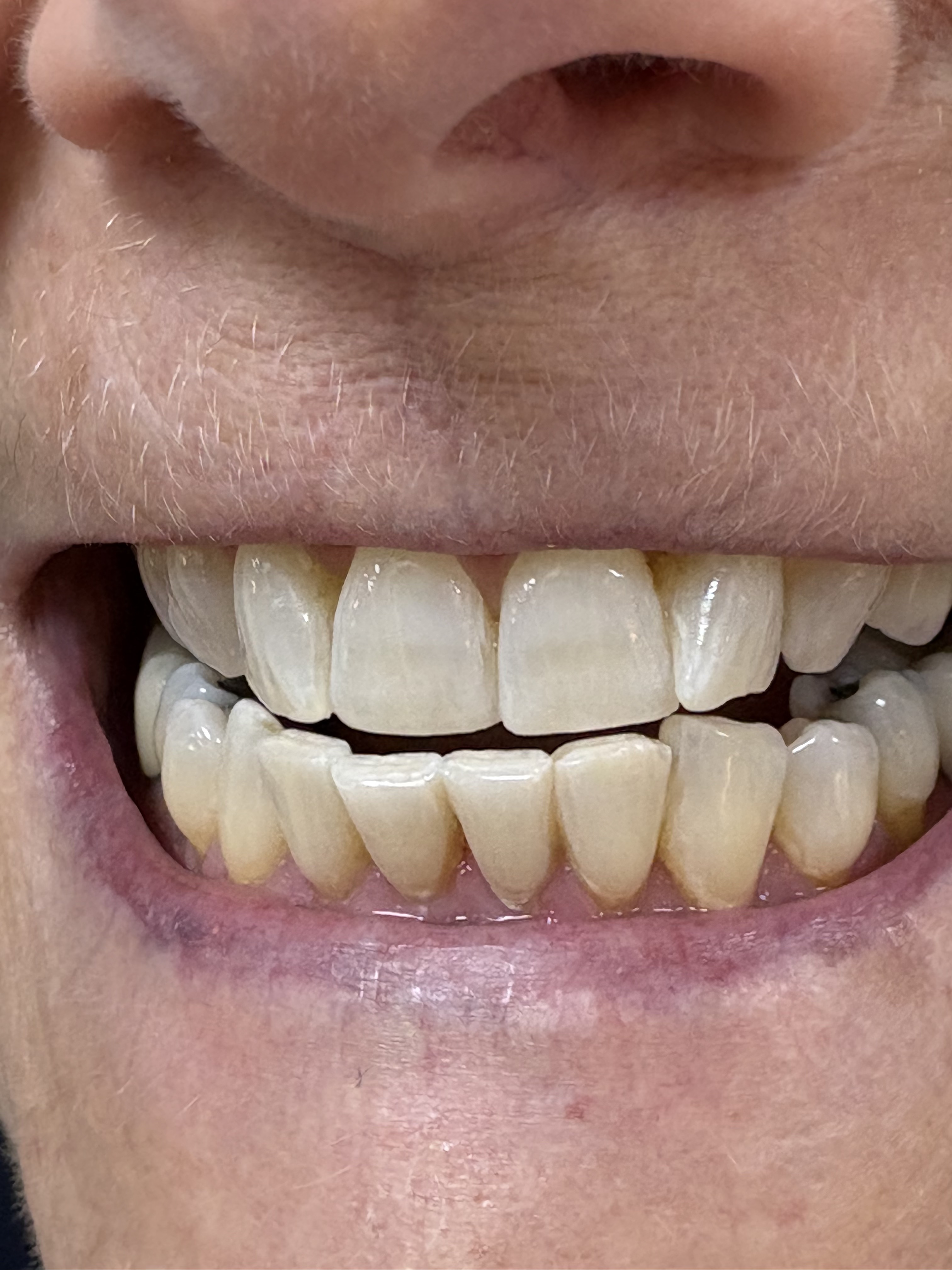 Professional Teeth Whitening after treatment at Aston Dental