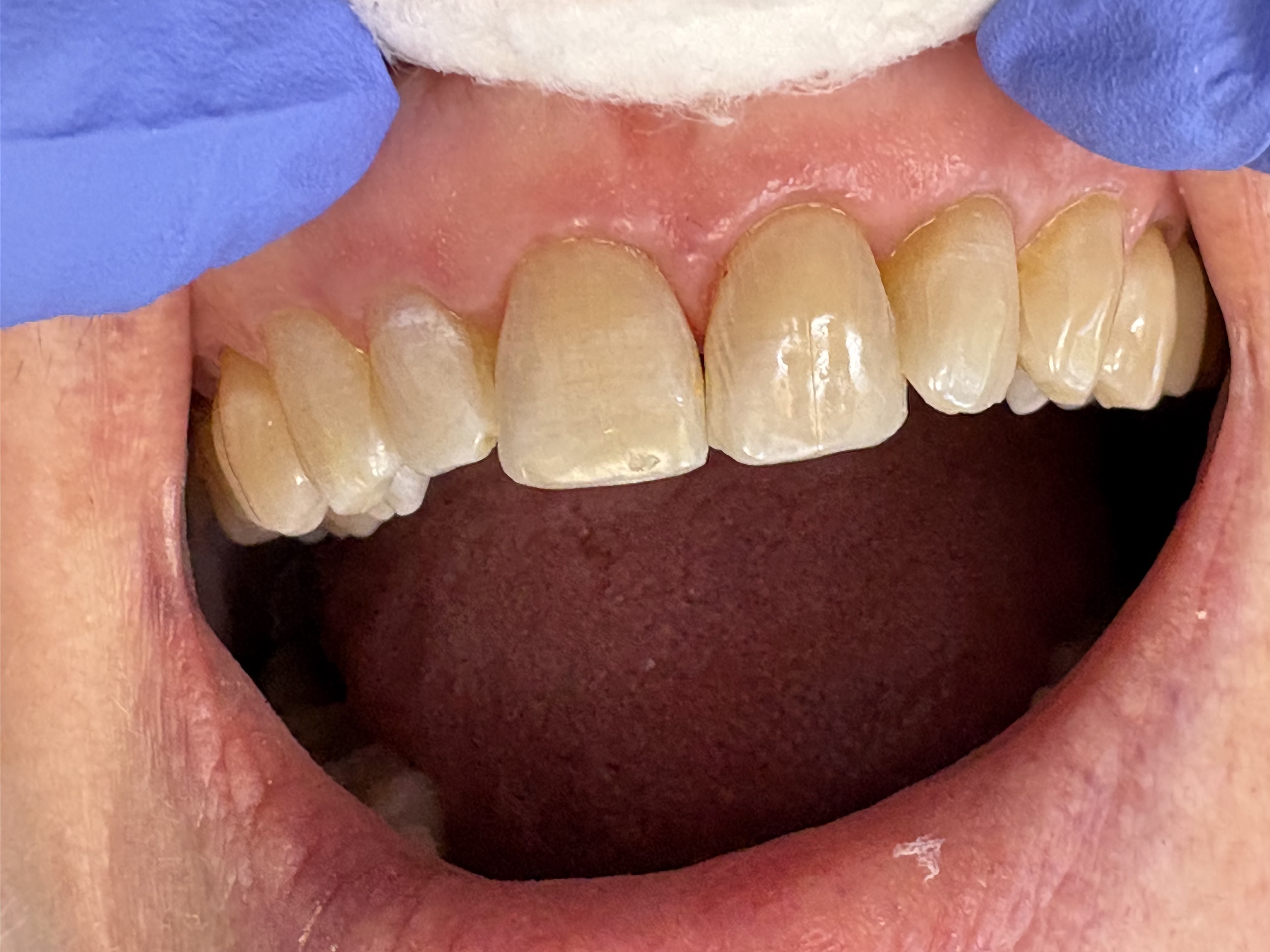Repairing Chipped Front Teeth after treatment at Aston Dental