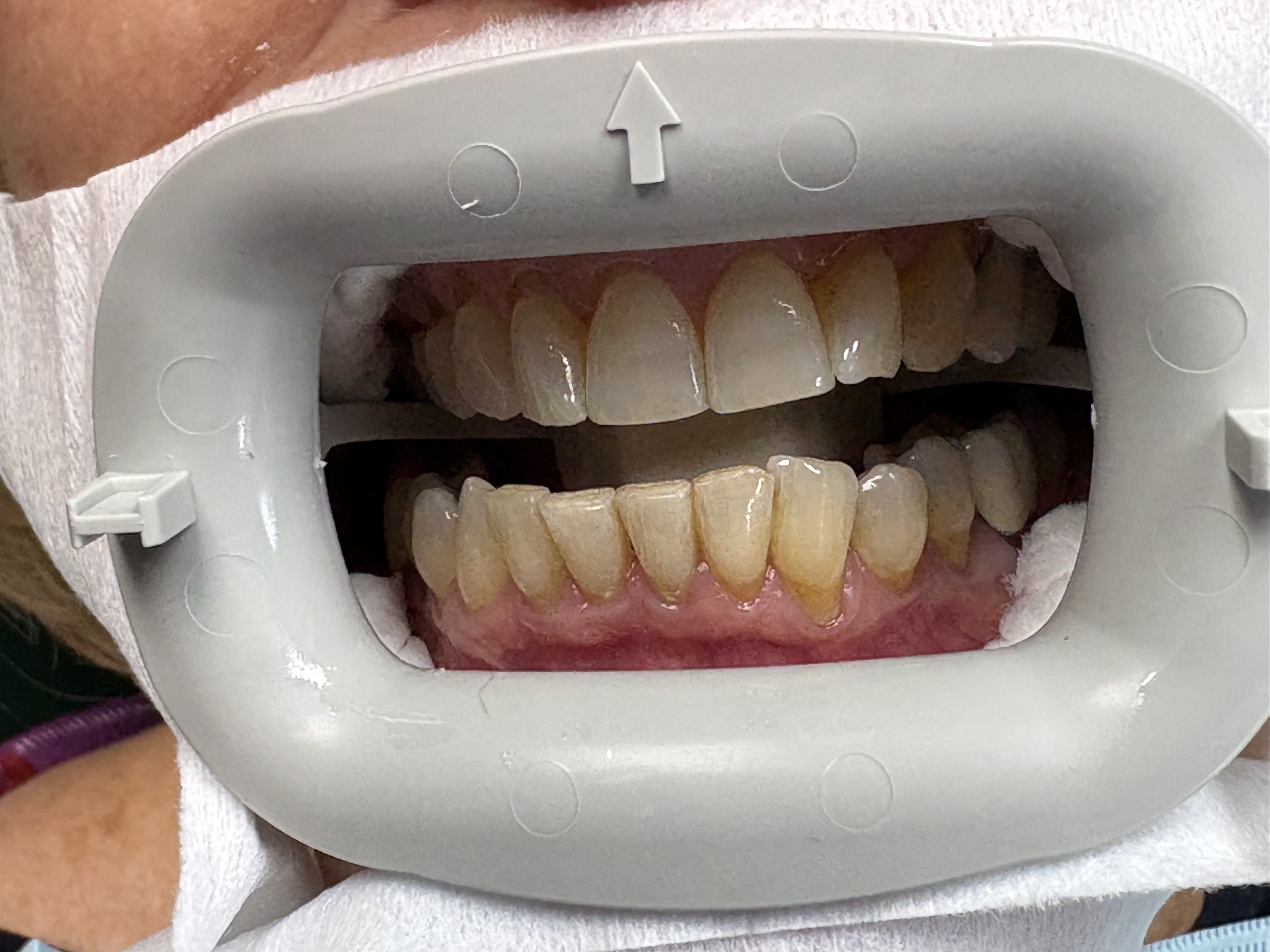 Professional Teeth Whitening before treatment at Aston Dental
