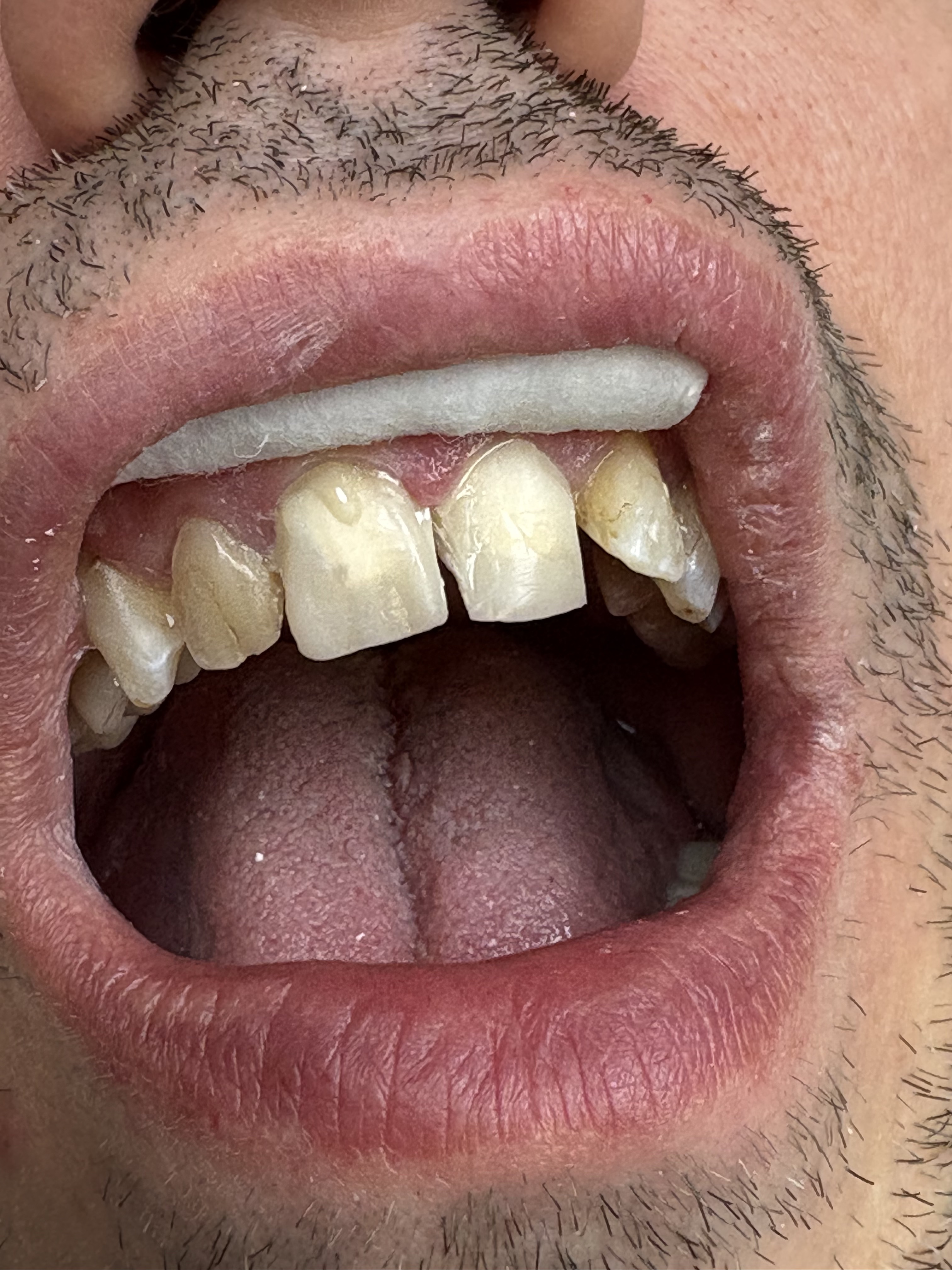 Cosmetic Porcelain Crowns before treatment at Aston Dental