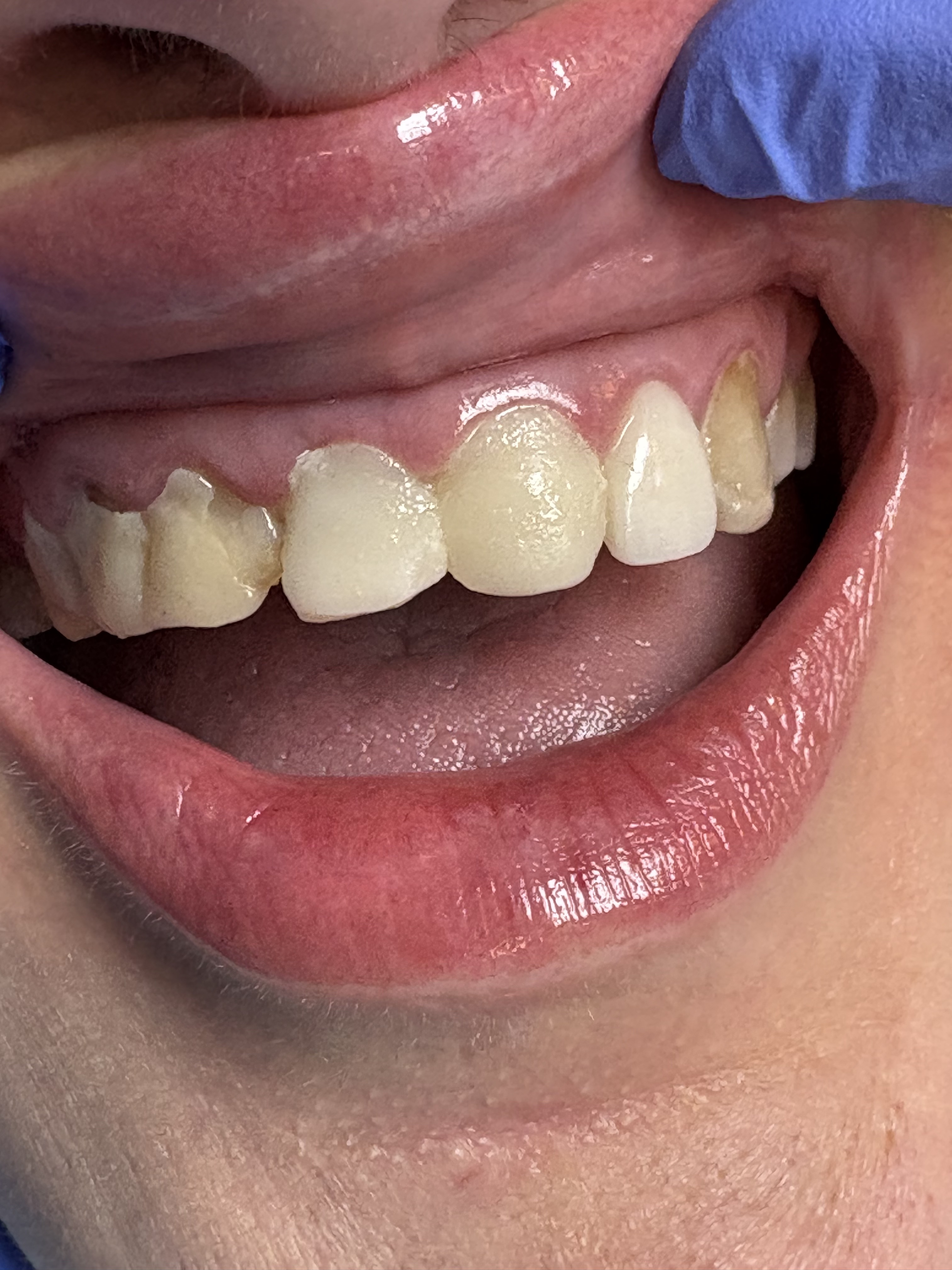 Staged Anterior Cosmetic Crowns before treatment at Aston Dental