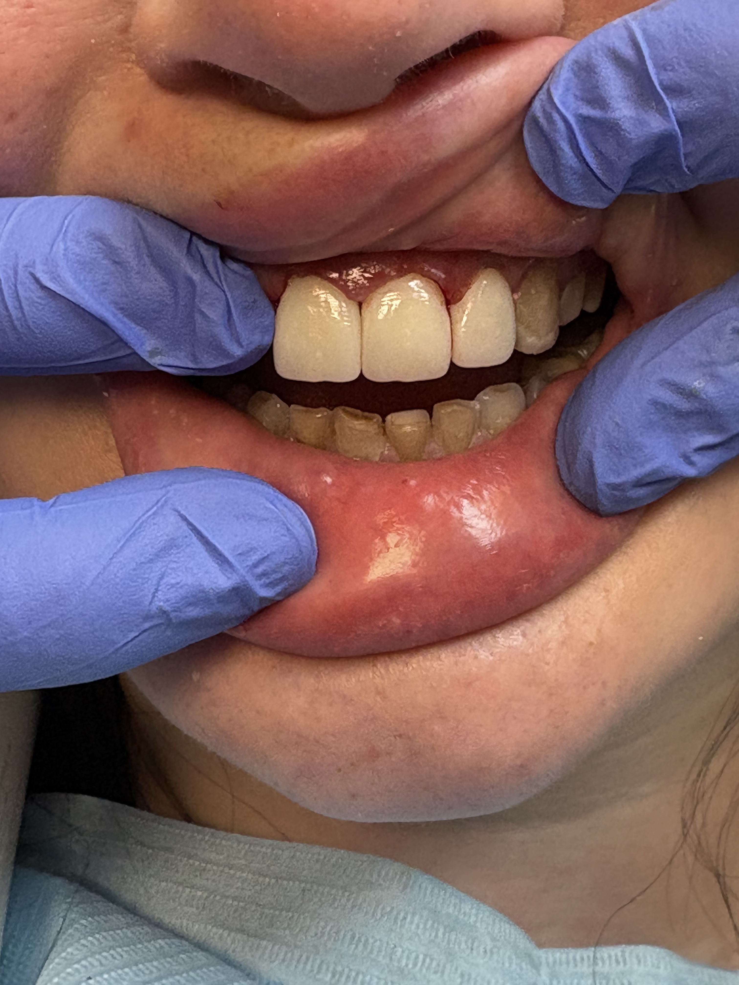 Staged Anterior Cosmetic Crowns after treatment at Aston Dental