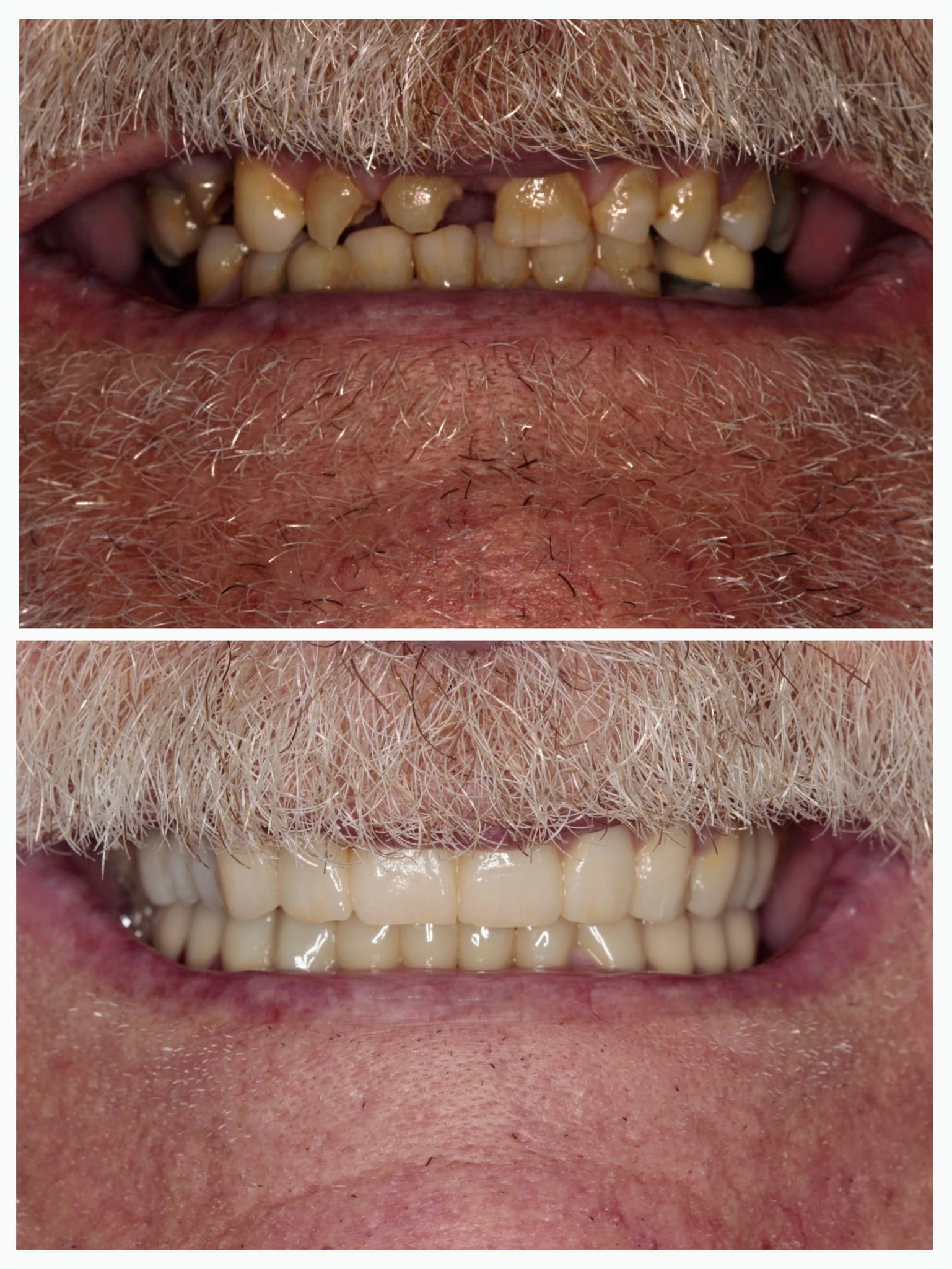 Antes y después de un paciente de Clinirehab