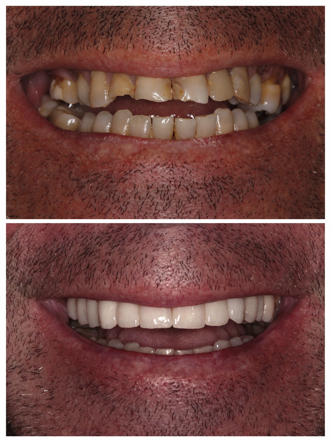 Antes y después de un paciente de Clinirehab