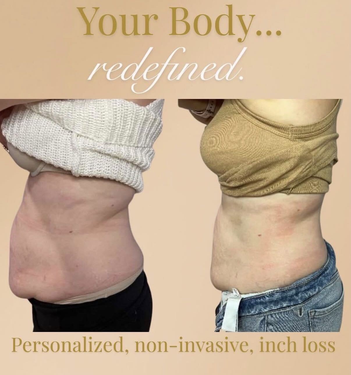 A client's midsection before and after cryo slimming