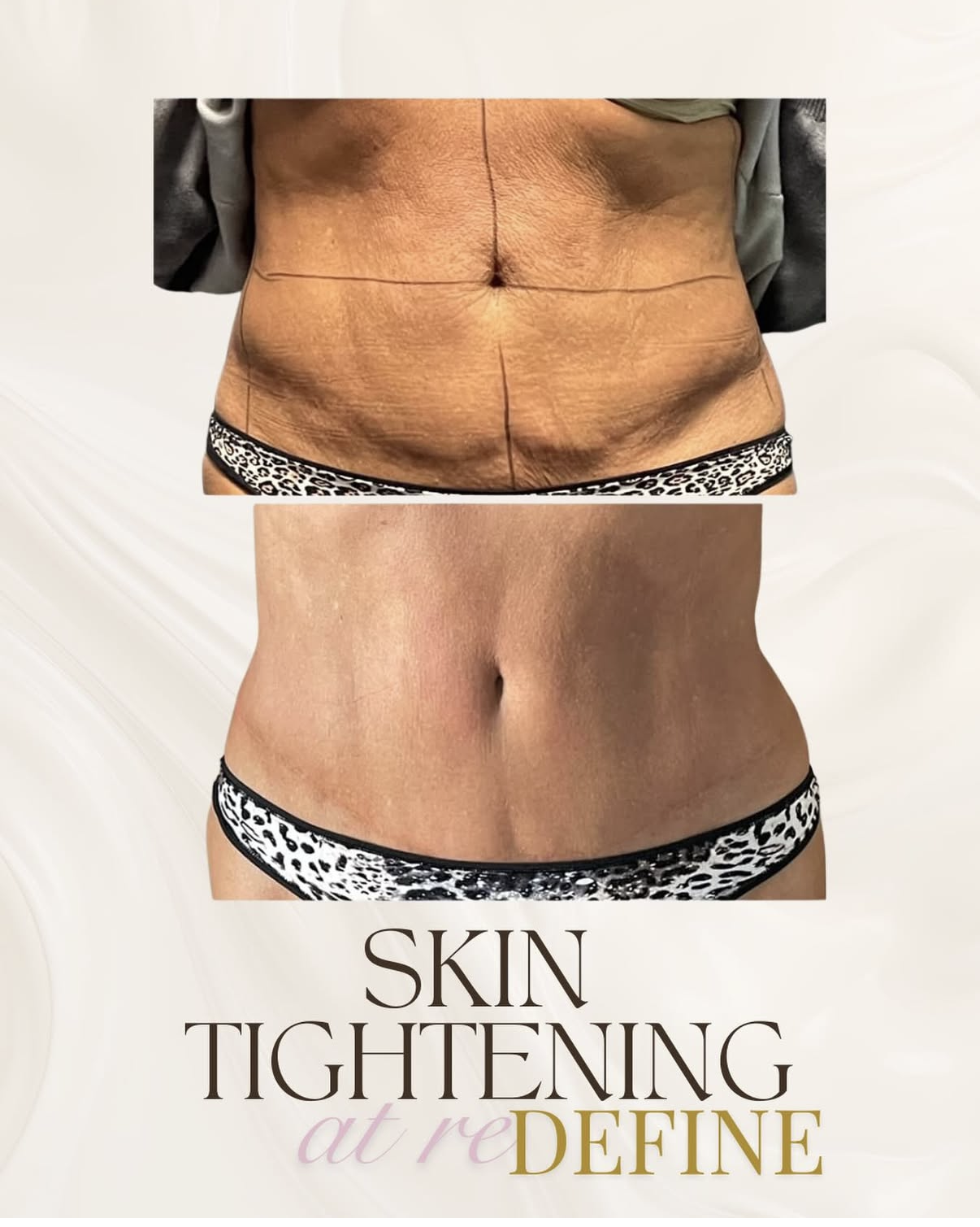 A client's abdomen before and after skin tightening