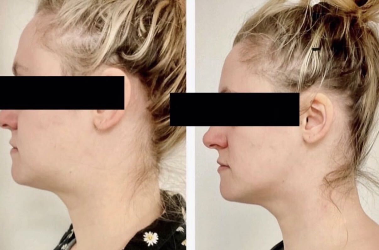 A client's neck and jawline before and after treatment