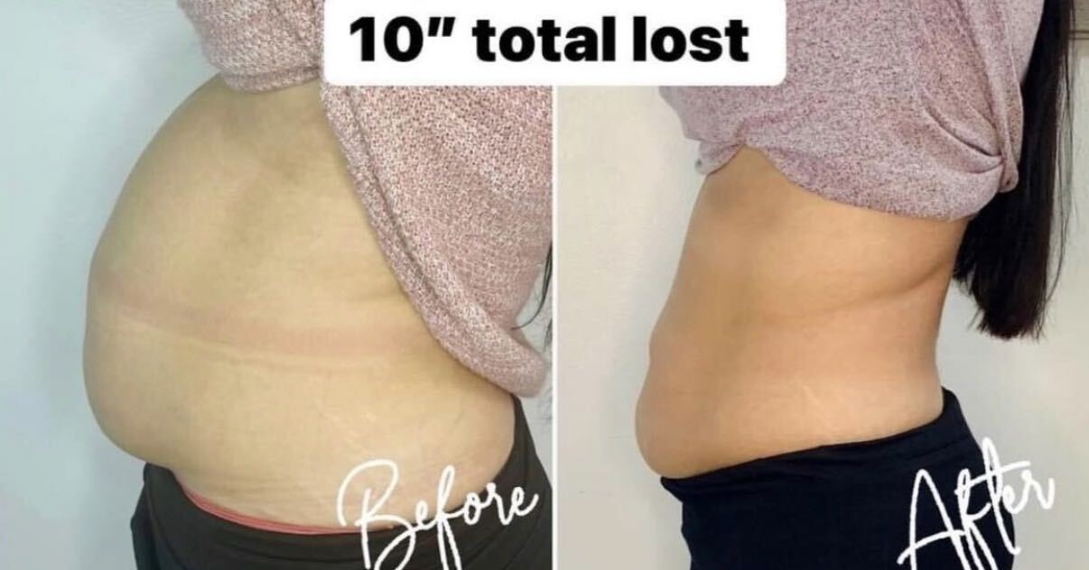 A client's stomach before and after cryo slimming, ten inches total lost