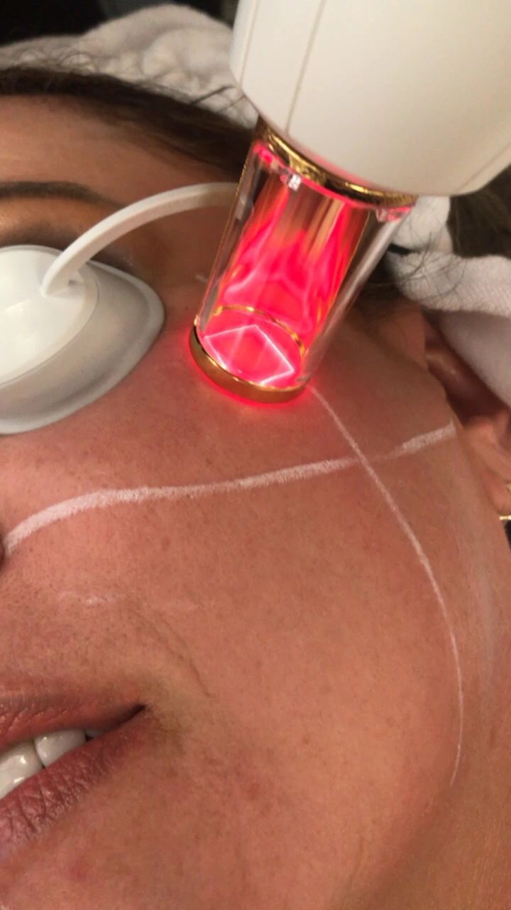 CO2 Laser Resurfacing