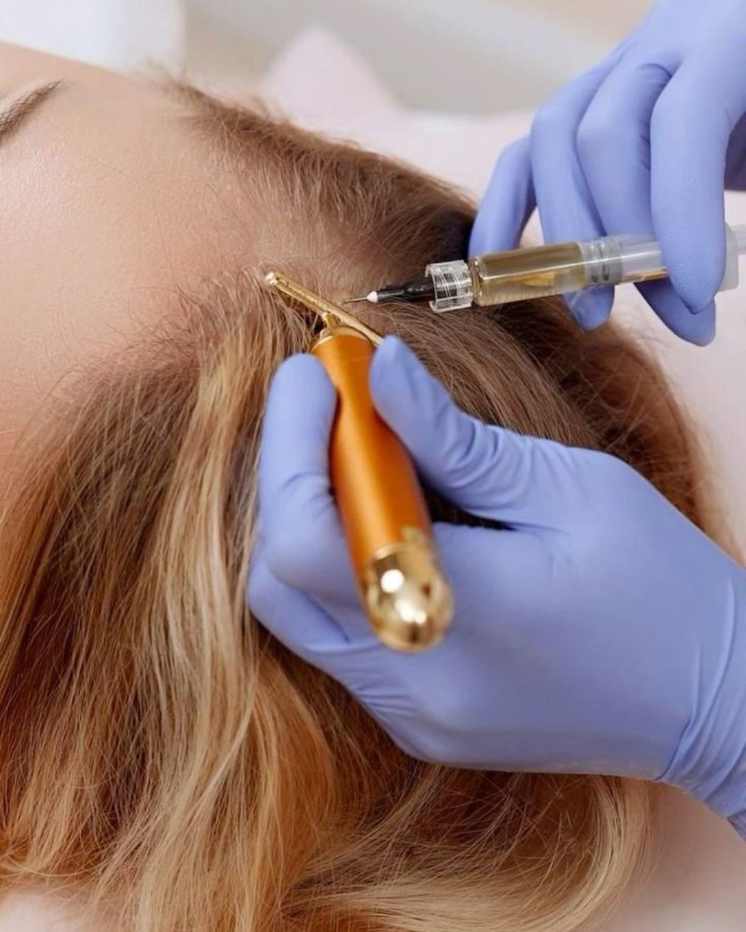 Hair Restoration Therapy