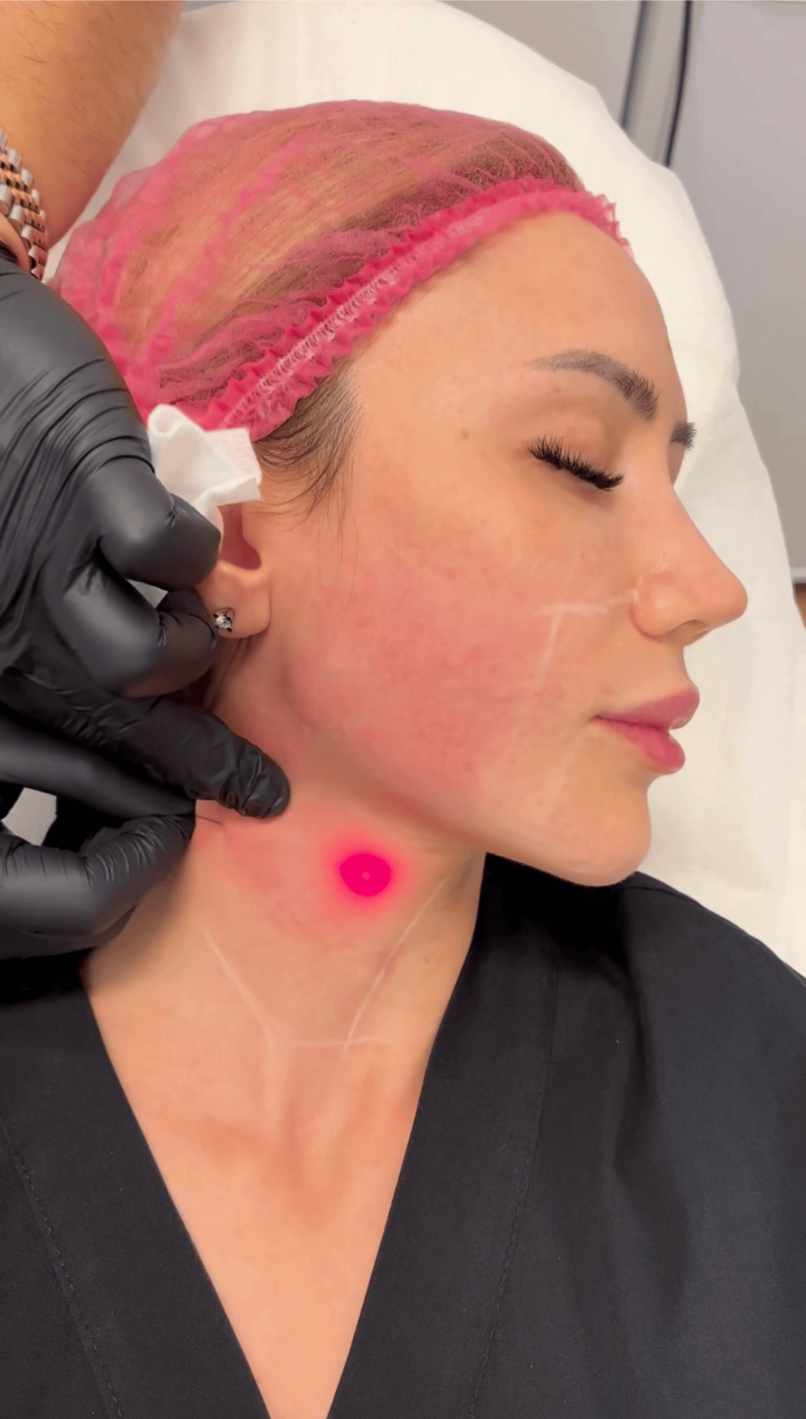 Endolift Laser