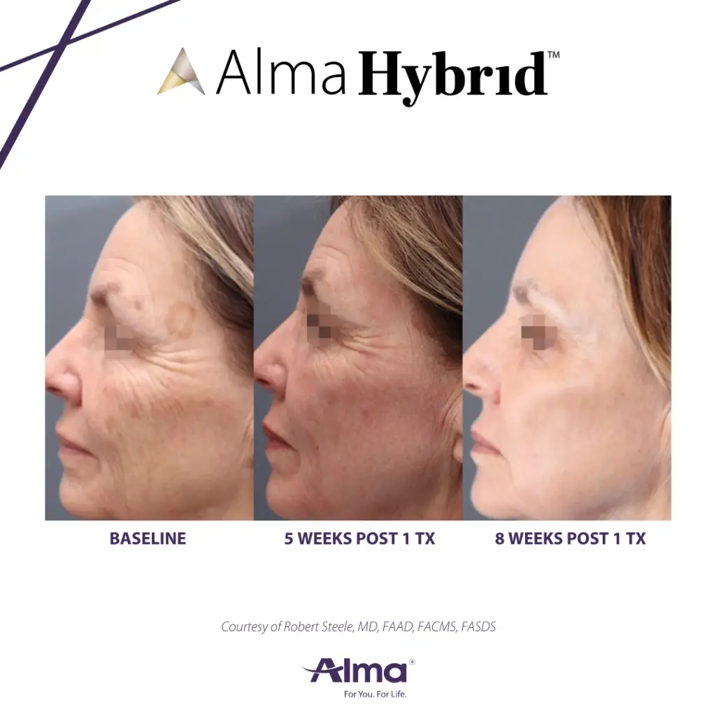 Alma Hybrid laser skin resurfacing treatment in San Marcos