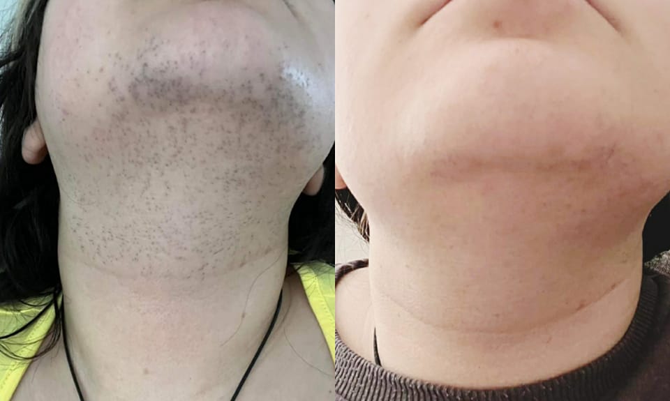 Client before and after laser hair removal result